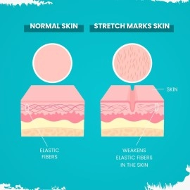 MildCares Stretch Marks Removal Cream (50gm) | For Prevents Stretch Marks, Nourish & Hydrating Skin | With Shea Butter, Saffron, Kokum Butters | All Skin Types | Stretch Marks Cream For Women