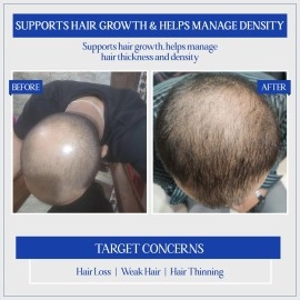 TYC - TRUST YOUR CHOICE Herbal Hair Growth Serum With 3% Redensyl, 1% Procapil & 1% Capilia Longa | Manages Hair Fall, Hair Thinning & Hair Loss | Encourage Hair Growth | Ph 5.5, 140 Grams