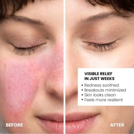 The True Therapy 10% Azelaic Acid Face Serum with Witch Hazel Extract for Anti-inflammatory, Cystic Acne, Rosacea, Hyperpigmentation, Reduce Redness, Excess Oil & Breakout - 30 ml