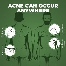 Beardo Body Acne Clear Body Wash for Men 200 ml | With Neem, Tea Tree and Salicylic Acid | Clean Clear Skin | For Body Acne and Skin Purification | B-acne