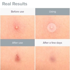 PRIVEDA Acne Pimple Patch 57 Units Hydrocolloid Made in Korea 3 Sizes 8mm 10mm 12mm Waterproof Sheet