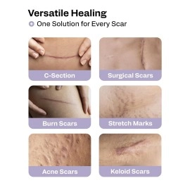 AWD Medical Silicone Scar Sheets Medical Grade Soft Silicone Gel Tape for Scar Removal (1.6 x 60) - Pack of 3