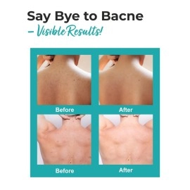 THE LOVE CO. CO Back Acne Body Spray 100Ml - 02% Salicylic Acid & Niacinamide for Back, Shoulder, Chest - Fast-Acting for Severe Acne, Unclogs Pores, Soothes Redness & Irritation