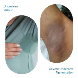 Be Bodywise Underarm Pigmentation Kit - No Fragrance | With 4% AHA BHA Underarm Roll-on (50ml) & Pigmentation Repair Cream (100g) | For Bright & Smooth Underarms | Fights Odour-Causing Bacteria, Fade