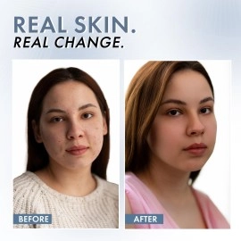 ThriveCo 10% Vitamin C Serum For Face With Hyaluronic Acid | Gives Instant Brightening Effect & Glowing Skin | For Men & Women | All Skin Types | Non-Sticky, Vegan, Fragrance & Cruelty-Free | 30ml