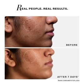 Novology Acne Reduction Serum | Face Serum for Acne, Whiteheads, Blackheads | With 0.1% Thymol + Terpineol | Specialised For Oily & Acne Prone Skin