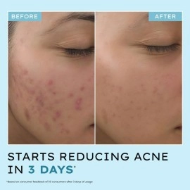 Hyphen Acne Defence Daily Serum For Acne Prone Skin with Salicylic acid 2%, Azelaic Acid 10%, Niacinamide 4% | Treats Active Acne, Controls Oil | AntiAcne Serum for Men & Women- 30 ml