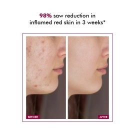 Conscious Chemist 10% Azelaic Acid Cream | 50g | Face Cream, Redness Relief, Soothe Irritation & Inflammation, Acne Treatment, For Sensitive To Rosacea, Prone Skin & All Skin Types - Azicalm