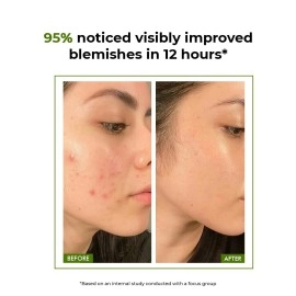 Conscious Chemist 2% Salicylic Acid Cream | 50g | Moisturizer for Oily Acne Prone Skin, For Acne Treatment, Oil Control, Soothe Irritation, Itchiness & Redness, Non-Greasy Gel Cream - Flashfix