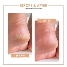 PROTOUCH Bliss Callus Remover | Rechargeable Electric Foot Scrubber for Dead Skin & Cracked Heels | 3 Roller Heads, 2 Speeds | Professional Pedicure Tool | 1 Year Doorstep Warranty