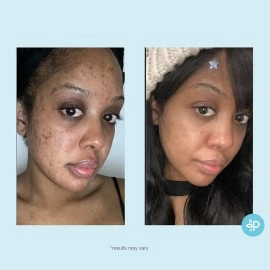 PERFECT IMAGE Salicylic 10% Gel Peel, Breakout and Pore Minimizer and Cleanser, 15-30 Full Facial Chemical Peels, 1 fl oz. e, 30 mL -