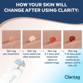 Claritag Advanced Skin Tag Remover - FDA-Cleared Device - Only for Skin Tag Removal - Works in 7-14 Days - Up to 10 Treatment Cycles - Cryogenic Freeze-Off Kit