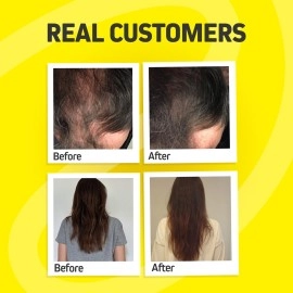 Herbtonics Foli-Tonic Advanced DHT Blocker To Stop Hair Loss, Hair Thinning & Help Thicker Hair Growth - Hair Regrowth Vitamin Supplement for Men and Women, 60 Vegan Capsules