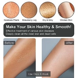 Yiclick Exfoliating Gloves 2 Pcs,Deep Exfoliating Mitt, Body Exfoliator, Exfoliating Body Scrubber for Bath Shower Exfoliation, for Dead Skin Remover, Leg Keratosis Pilaris Treatment