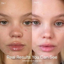 Solawave Bye Acne Spot Treatment, Red Light Therapy and Blue Light Therapy, Use Before Pimple Patches. Acne Light Device, Face Care Must-Have